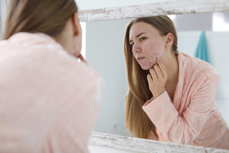 Dairy Leads to Acne